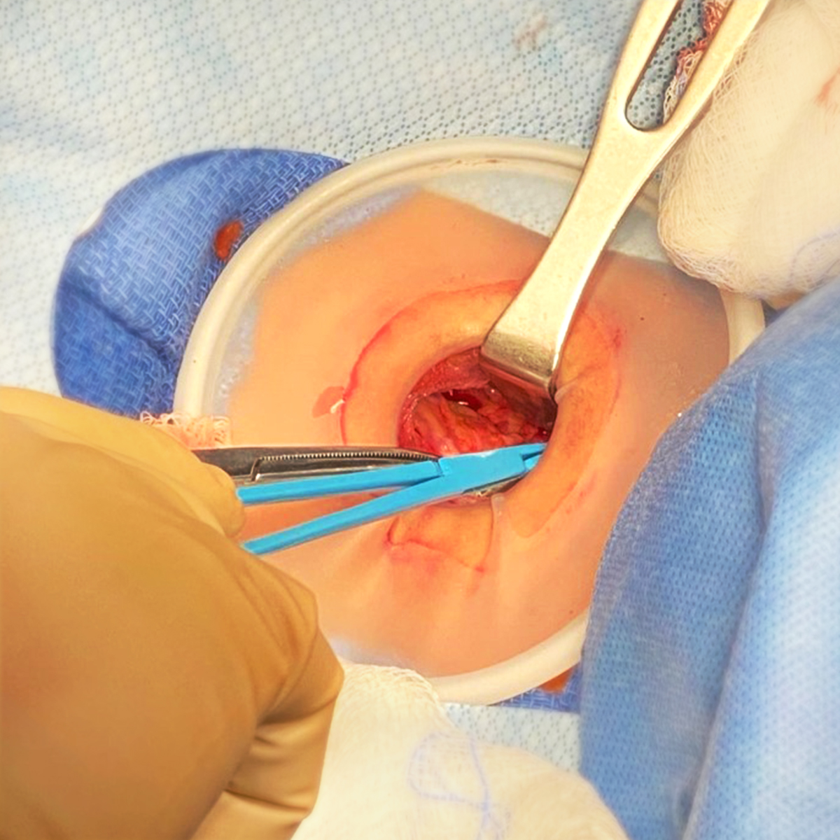Dual-Ring, Fixed-Height Wound Protector In Use During Thyroidectomy