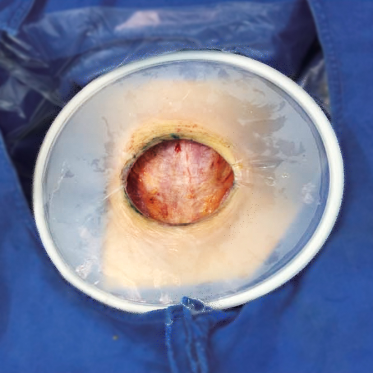 Dual-Ring, Fixed-Height Wound Protector In Use During Surgery