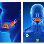 Nerveäna Plus nerve monitoring system. Intraoperative Neuromonitoring, Hypoglossal Nerve Monitoring, HNS THerapy