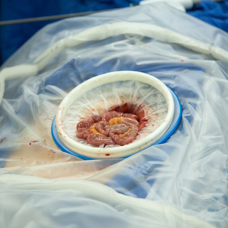 ViClean dual-ring wound protectors, advance Surgical Site Infection Prevention